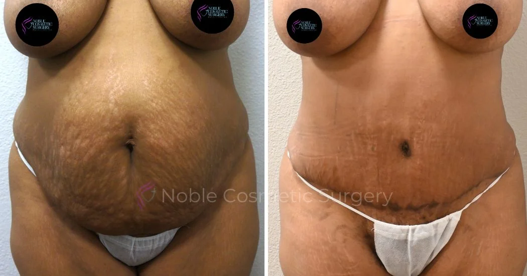 TUMMY-TUCK-CASE-00033 | Before and After Abdominoplasty 1