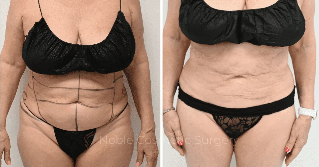 LIPOSUCTION-CASE-10145 | Before and After Liposuction 1