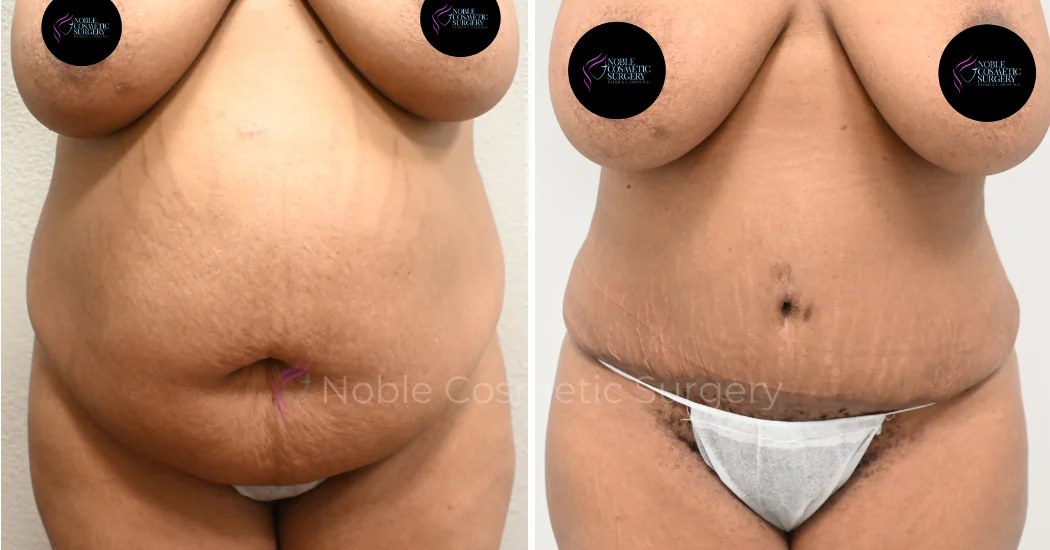 TUMMY-TUCK-CASE-00035 | Before and After Abdominoplasty 1