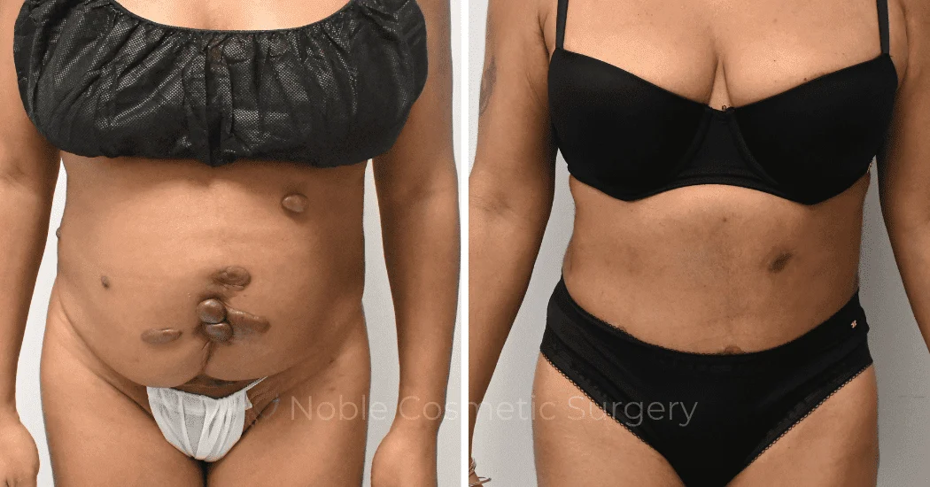 TUMMY-TUCK-CASE-10972 | Before and After Abdominoplasty 1