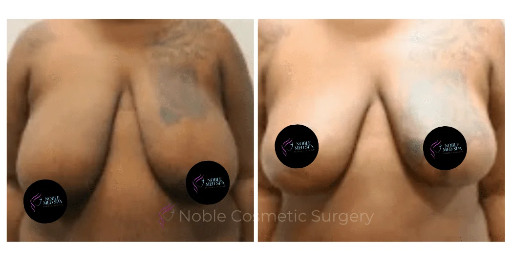 BREAST-REDUCTION-CASE-18364 | Before and After Breast Reduction 1