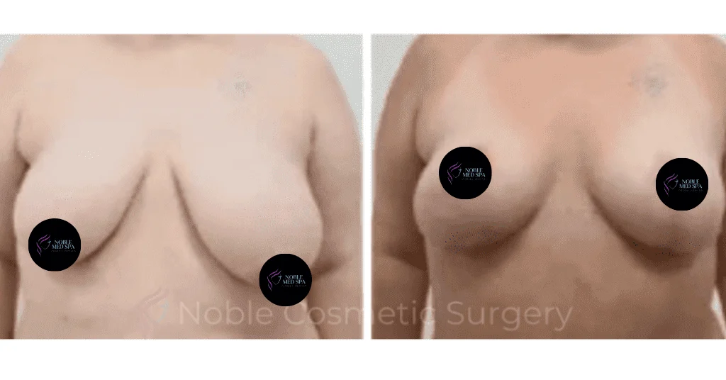 BREAST-REDUCTION-CASE-19223 | Before and After Breast Reduction 1