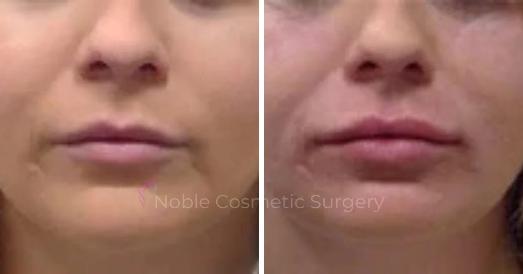 DERMAL-FILLERS-CASE-00258 | Before and After Dermal Fillers 1