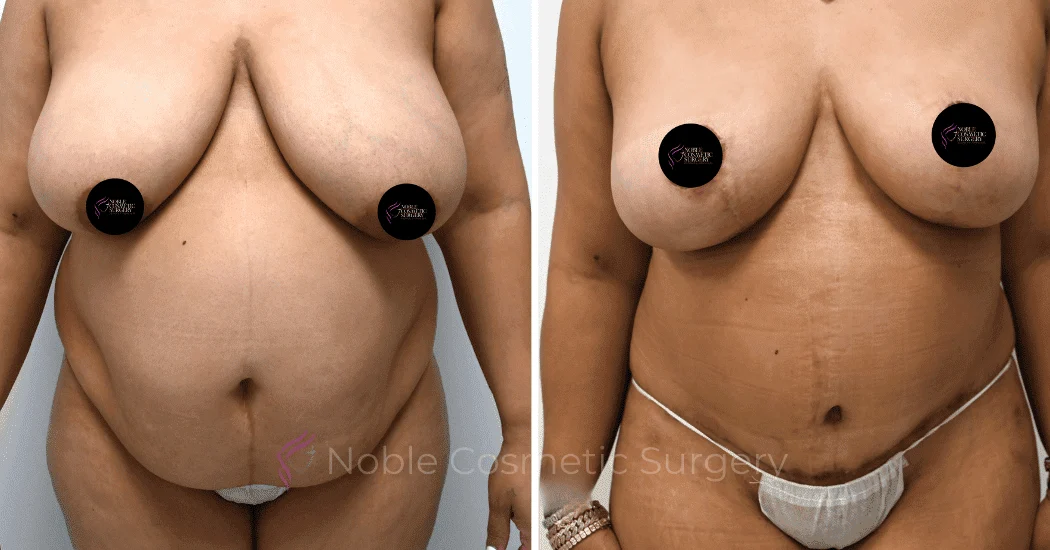MOMMY-MAKEOVER-CASE-11303 | Before and After Mommy Makeover 1