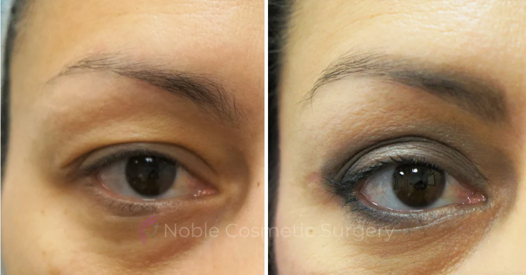 BLEPHAROPLASTY-CASE-16936 | Before and After Blepharoplasty 2