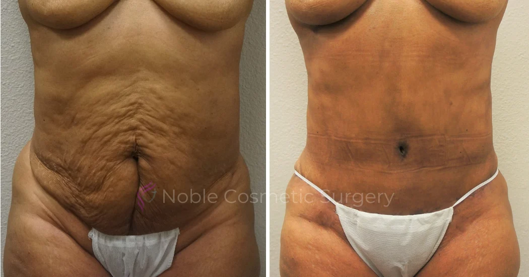 TUMMY-TUCK-CASE-00052 | Before and After Abdominoplasty 1