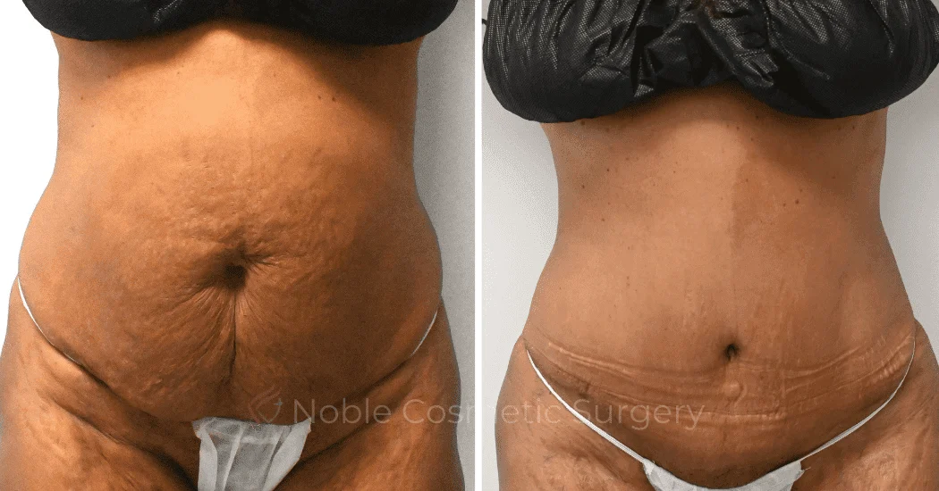 TUMMY-TUCK-CASE-10626 | Before and After Abdominoplasty 1