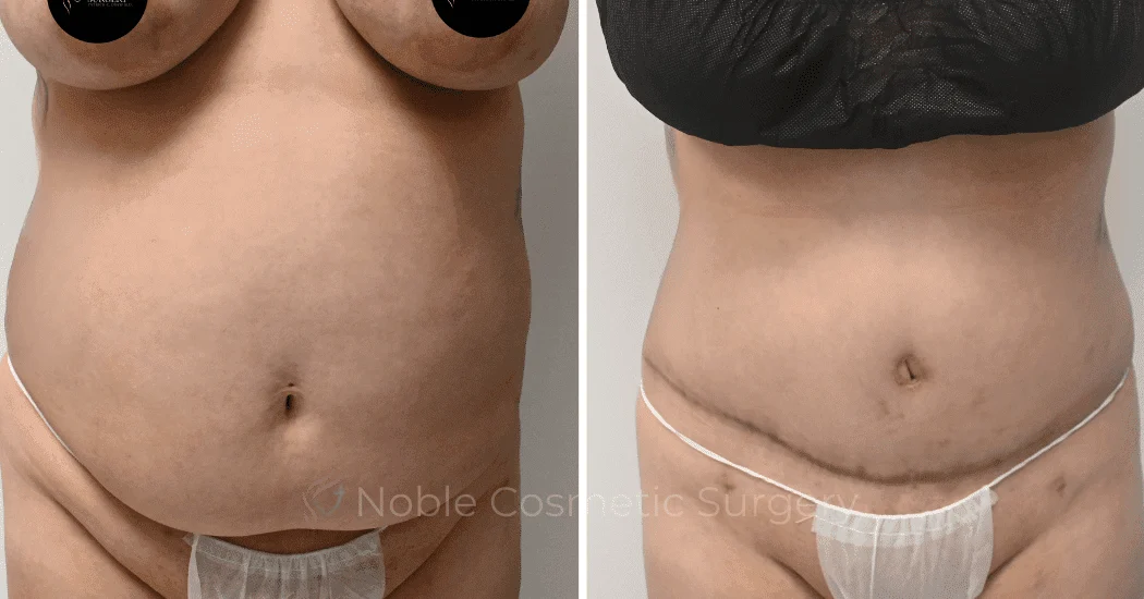 TUMMY-TUCK-CASE-10538 | Before and After Abdominoplasty 1