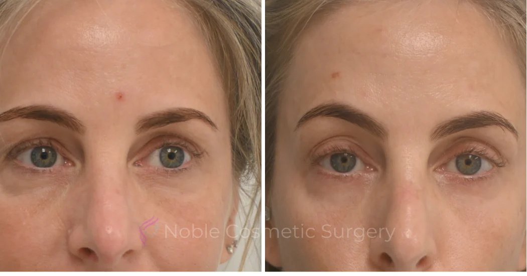 LIQUID-RHINOPLASTY-CASE-10007 | Before and After Liquid Rhinoplasty 1