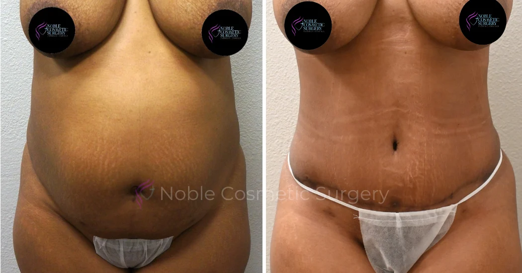 TUMMY-TUCK-CASE-00034 | Before and After Abdominoplasty 1