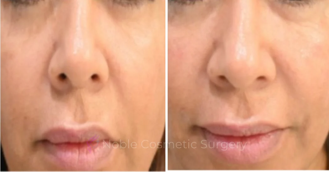 LIQUID-RHINOPLASTY-CASE-10004 | Before and After Liquid Rhinoplasty 1