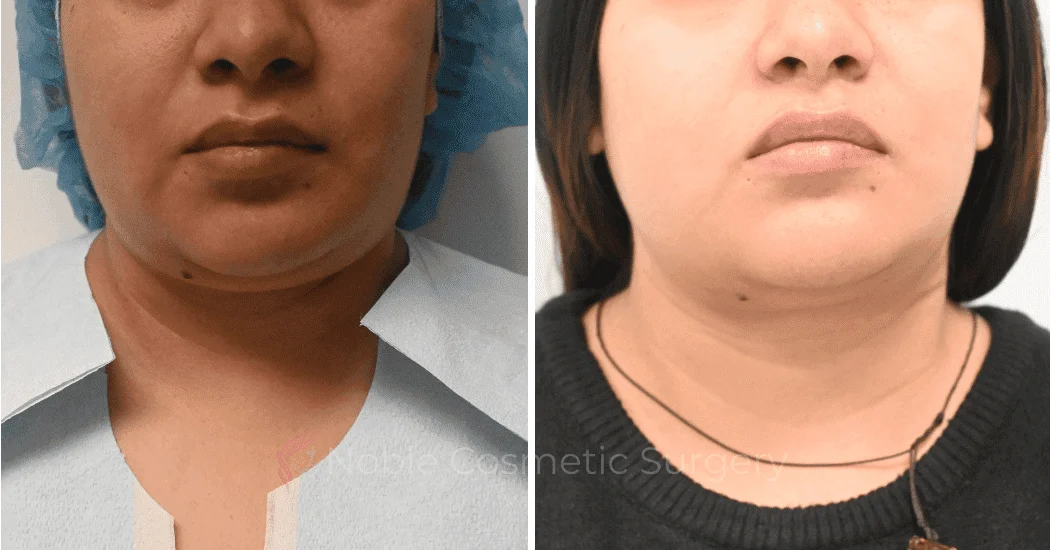 SUBMENTAL-LIPOSUCTION-CASE-10071 | Before and After Chin Liposuction 1