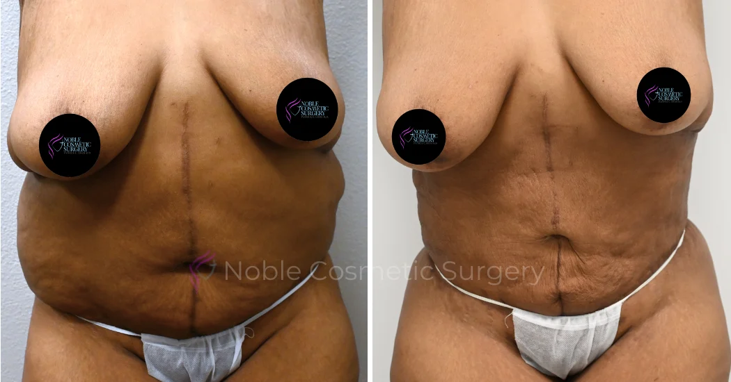 TUMMY-TUCK-CASE-00036 | Before and After Abdominoplasty 1