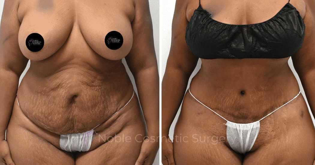 TUMMY-TUCK-CASE-14814 | Before and After Abdominoplasty 1