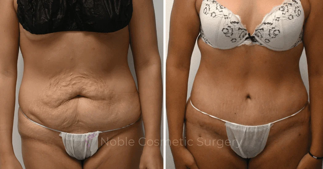TUMMY-TUCK-CASE-12792 | Before and After Abdominoplasty 1