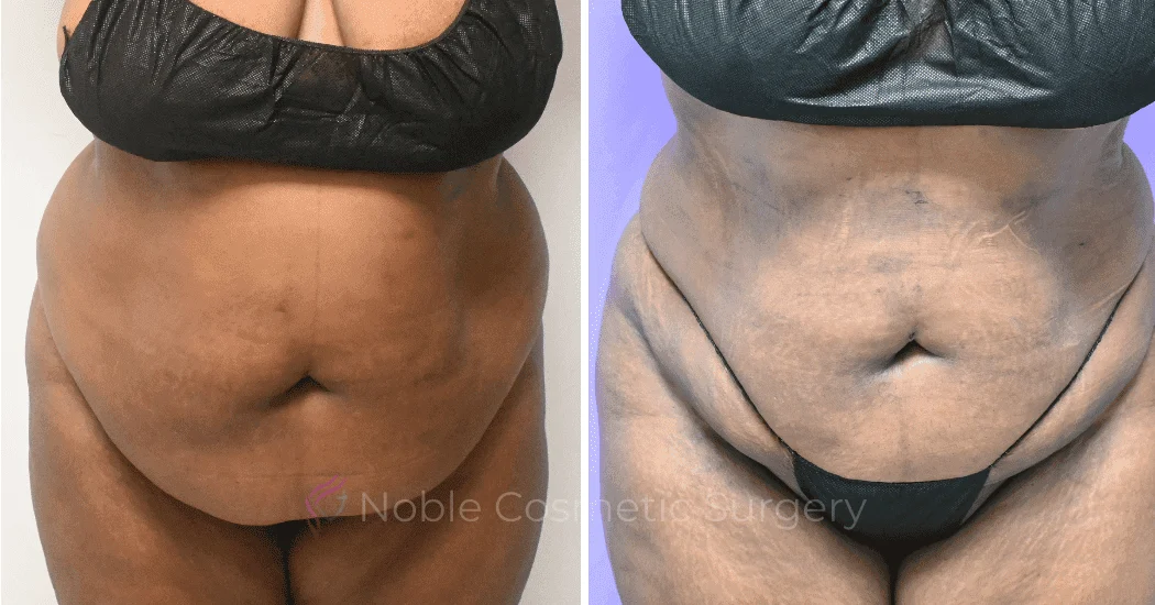 LIPOSUCTION-ABDOMEN-CASE-19096 | Before and After Liposuction 1