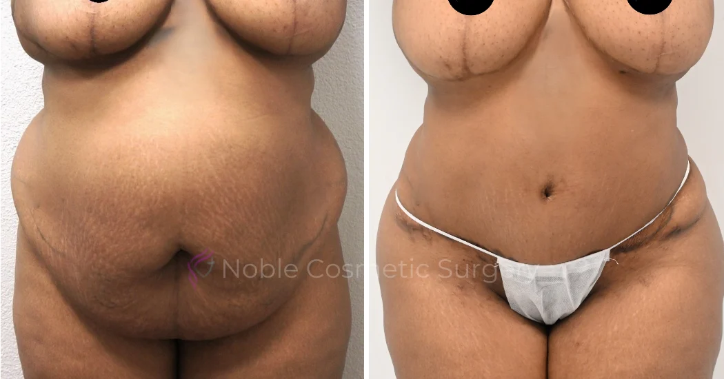 TUMMY-TUCK-CASE-00038 | Before and After Abdominoplasty 1