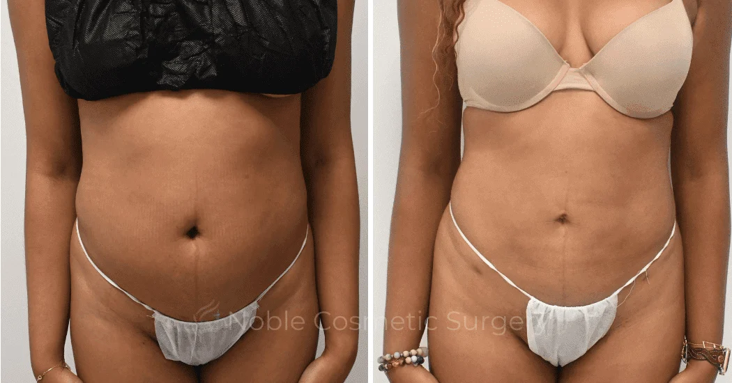 LIPOSUCTION-ABDOMEN-CASE--10533 | Before and After Liposuction 1