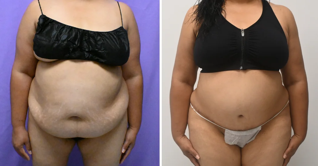 Case--10177 | Before and After Abdominoplasty 1