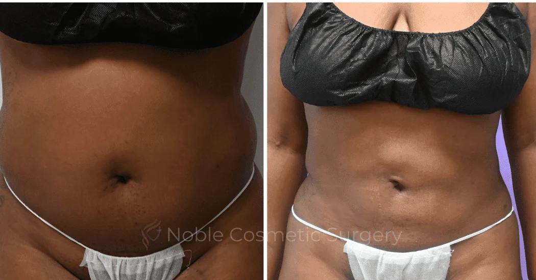 LIPOSUCTION-ABDOMEN-CASE-10873 | Before and After Liposuction 1