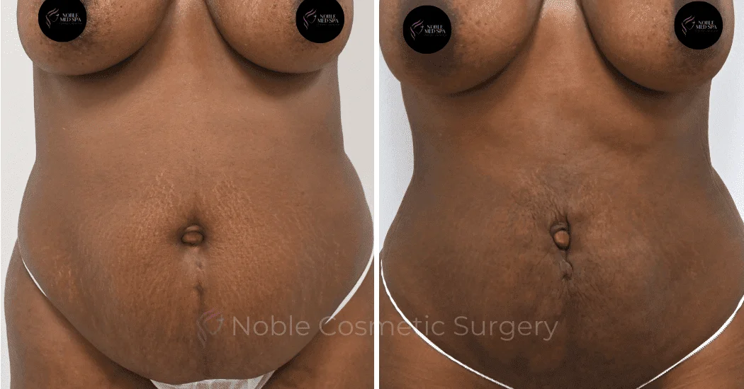 LIPOSUCTION-ABDOMEN-CASE-12901 | Before and After Liposuction 1