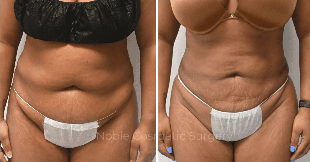 LIPOSUCTION-ABDOMEN-CASE-16787 | Before and After Liposuction 1
