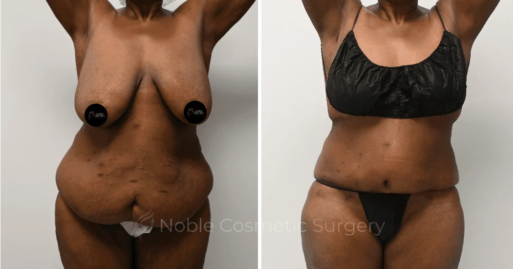 TUMMY-TUCK-CASE-11910 | Before and After Abdominoplasty 1