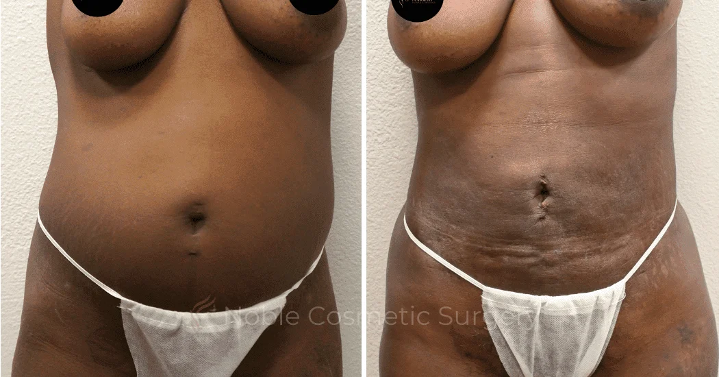 LIPOSUCTION-ABDOMEN-CASE-15104 | Before and After Liposuction 1