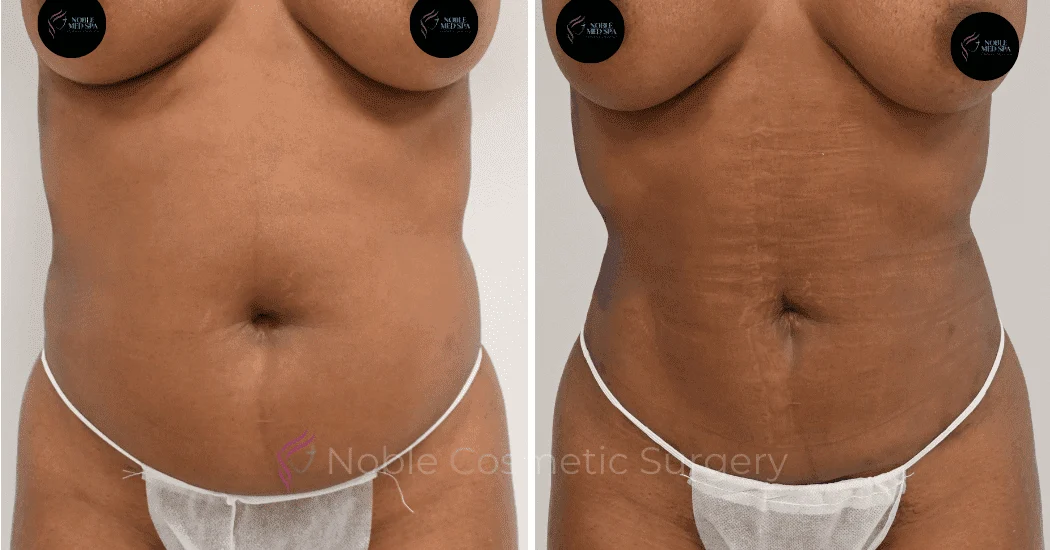 LIPOSUCTION-ABDOMEN-CASE-12590 | Before and After Liposuction 1