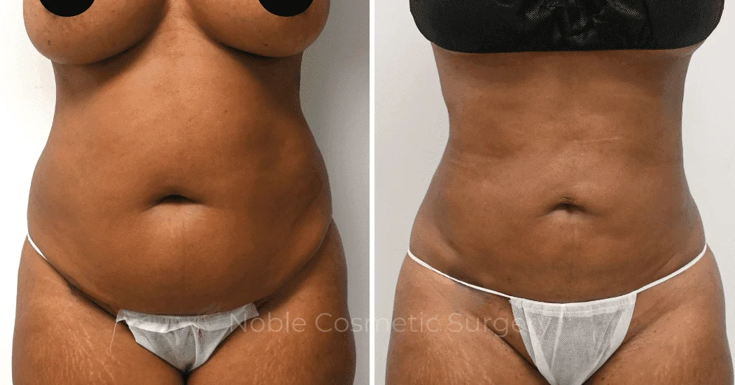LIPOSUCTION-ABDOMEN-CASE-11016 | Before and After Liposuction 1