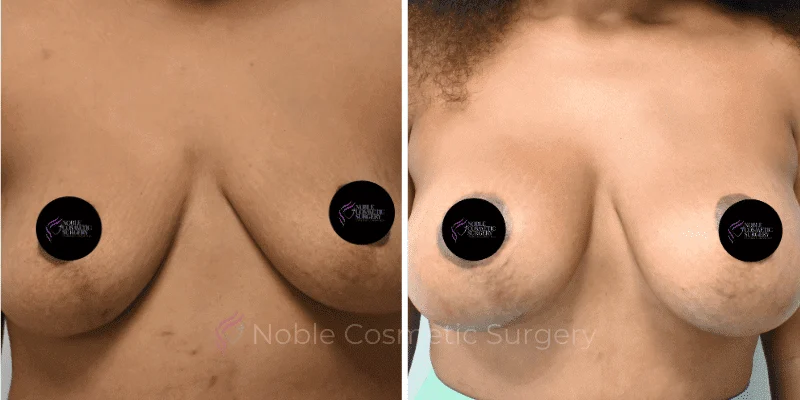 BREAST-AUGMENTATION-CASE-11356 | Before and After Breast Augmentation 1