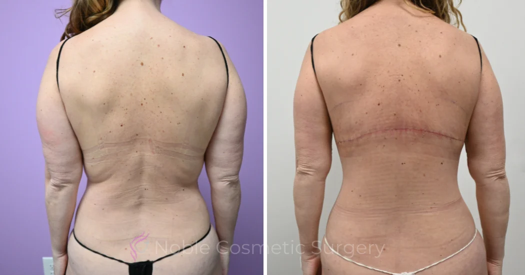 Case--20309 | Before and After Back Lift 1