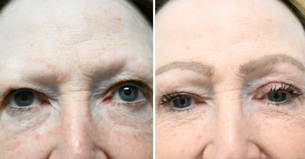 Case--18940 | Before and After Blepharoplasty 1