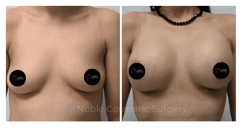 BREAST-AUGMENTATION-CASE-11661 | Before and After Breast Augmentation 1