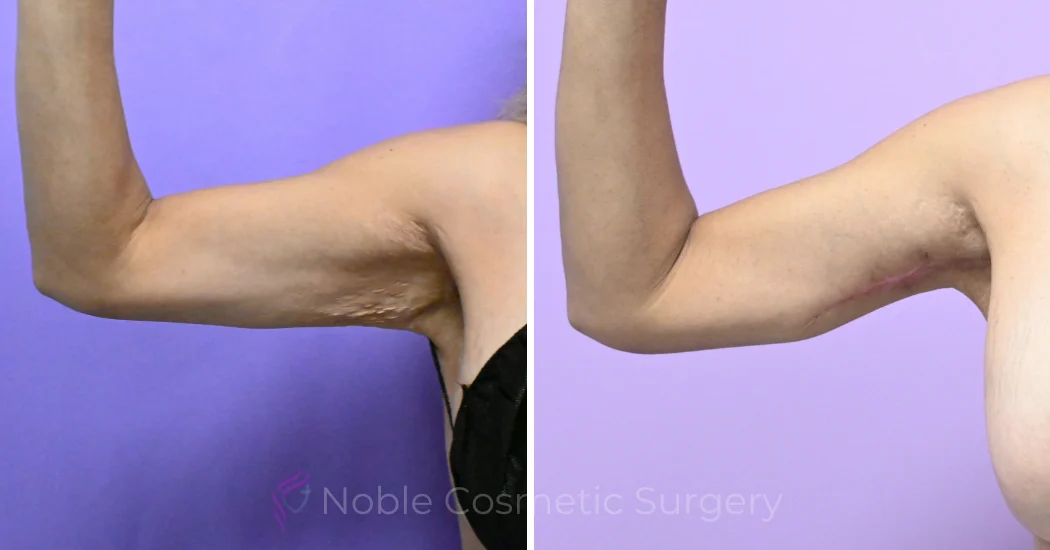 Case--20186 | Before and After Brachioplasty 1