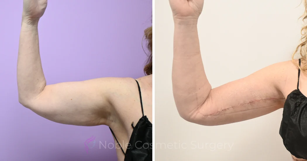 Case--20309 | Before and After Brachioplasty 1