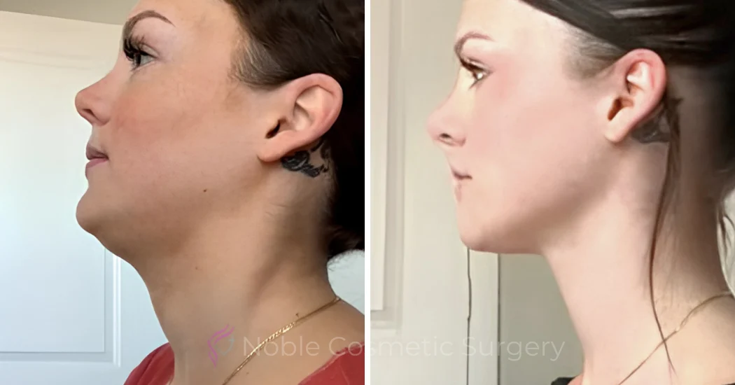 Case--20184 | Before and After Chin Liposuction 1