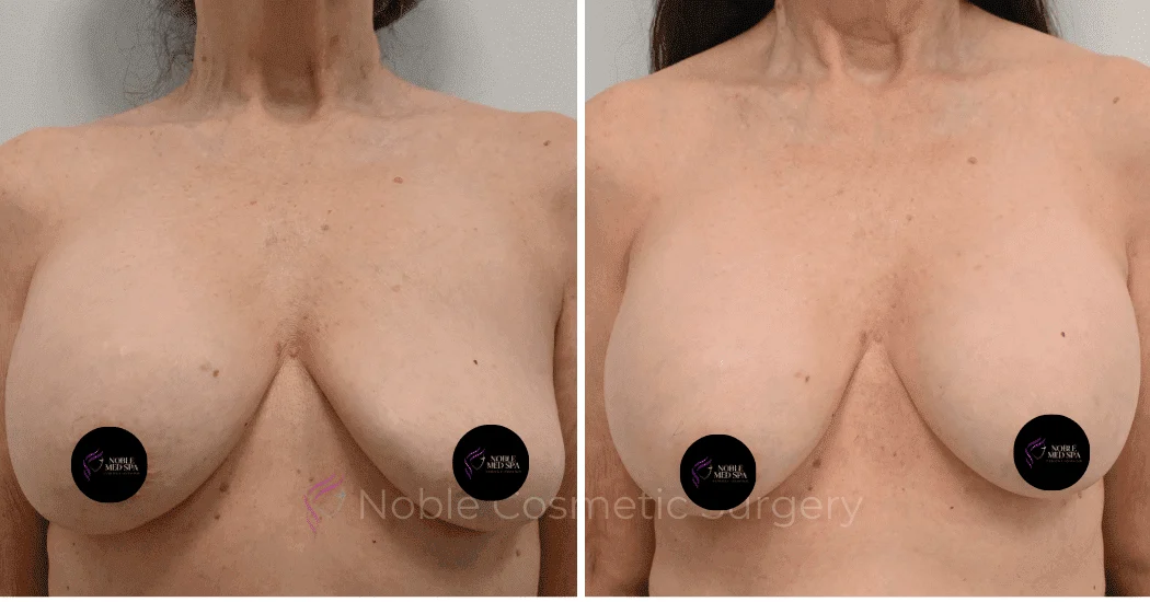 BREAST-AUGMENTATION-CASE-12085 | Before and After Breast Augmentation 1