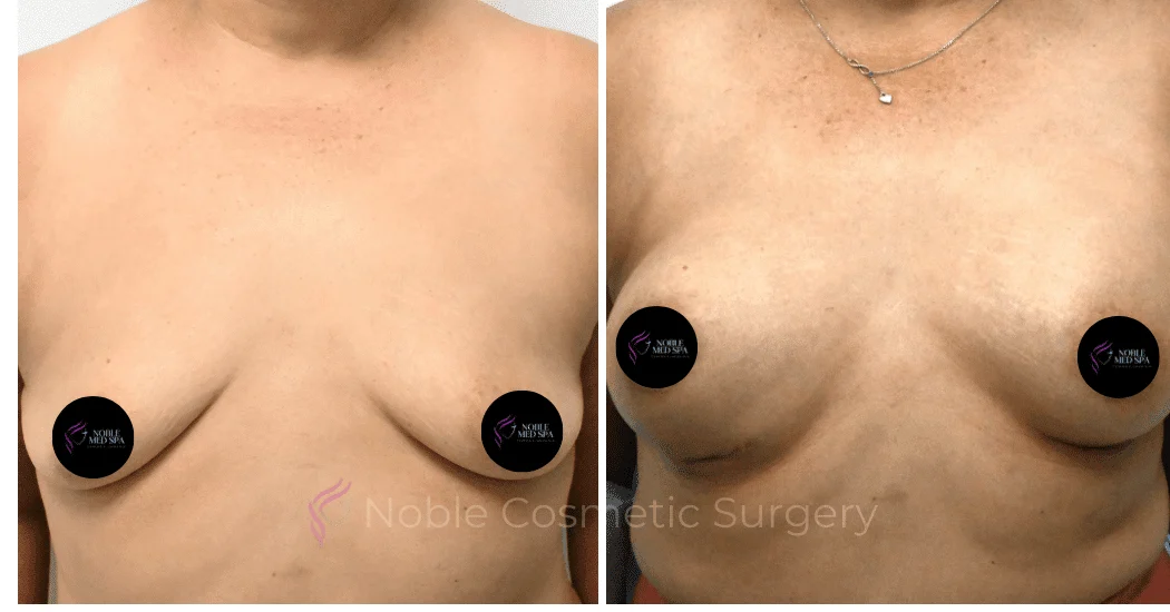 BREAST-AUGMENTATION-CASE-10545 | Before and After Breast Augmentation 1