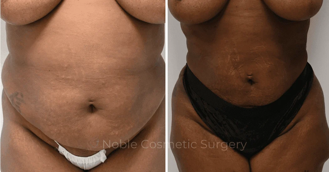 LIPOSUCTION-ABDOMEN-CASE-15837 | Before and After Liposuction 1