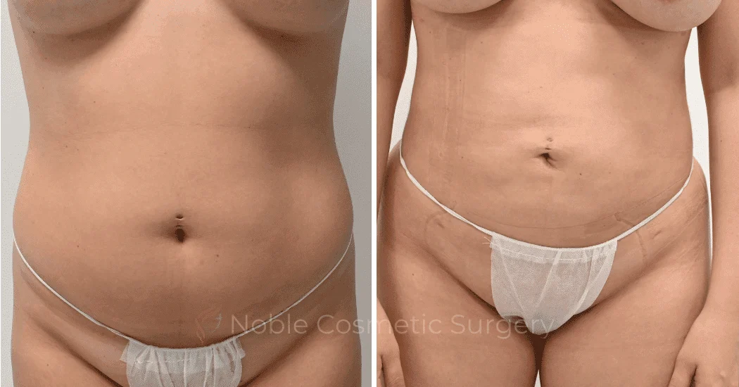 LIPOSUCTION-CASE-11801 | Before and After Liposuction 1