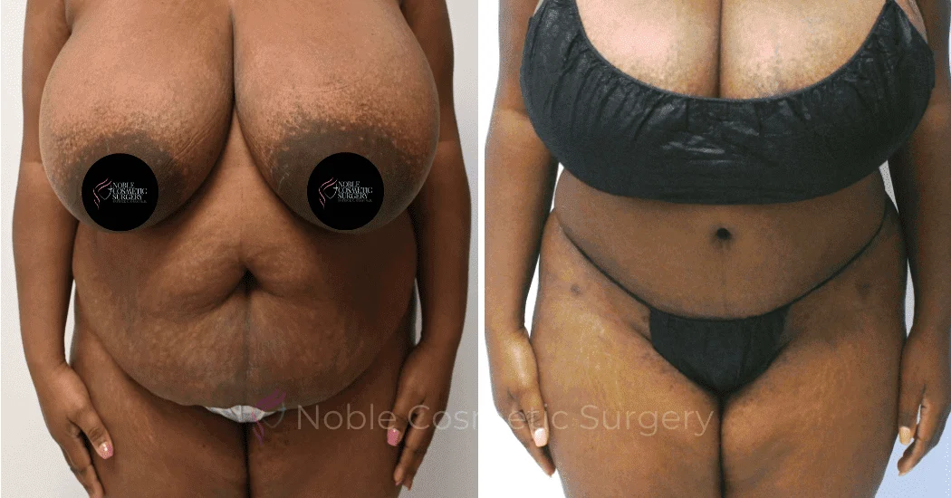 TUMMY-TUCK-CASE-11720 | Before and After Abdominoplasty 1