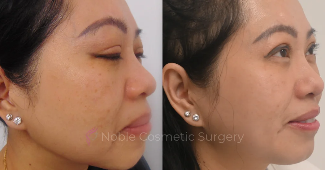 PICO-LASER-CASE-00003 | Before and After Pico Skin Rejuvenation 1