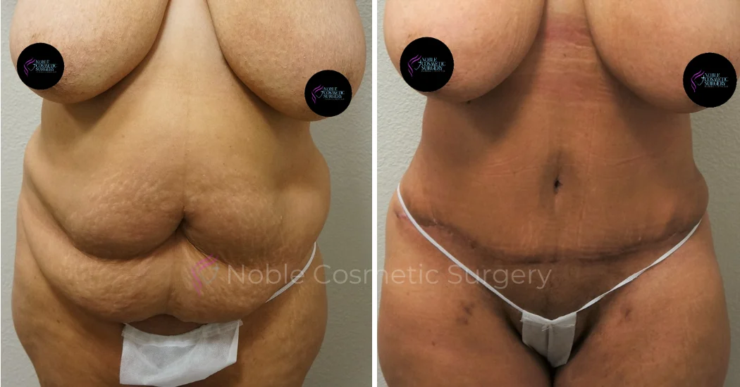 TUMMY-TUCK-CASE-00043 | Before and After Abdominoplasty 1