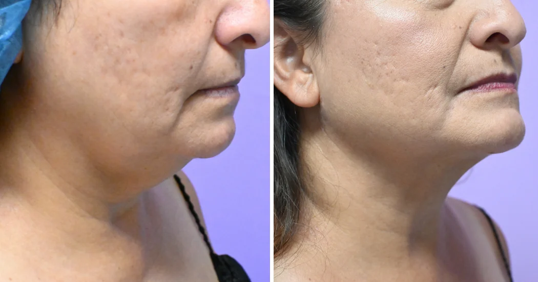 Case--19506 | Before and After Chin Liposuction 1