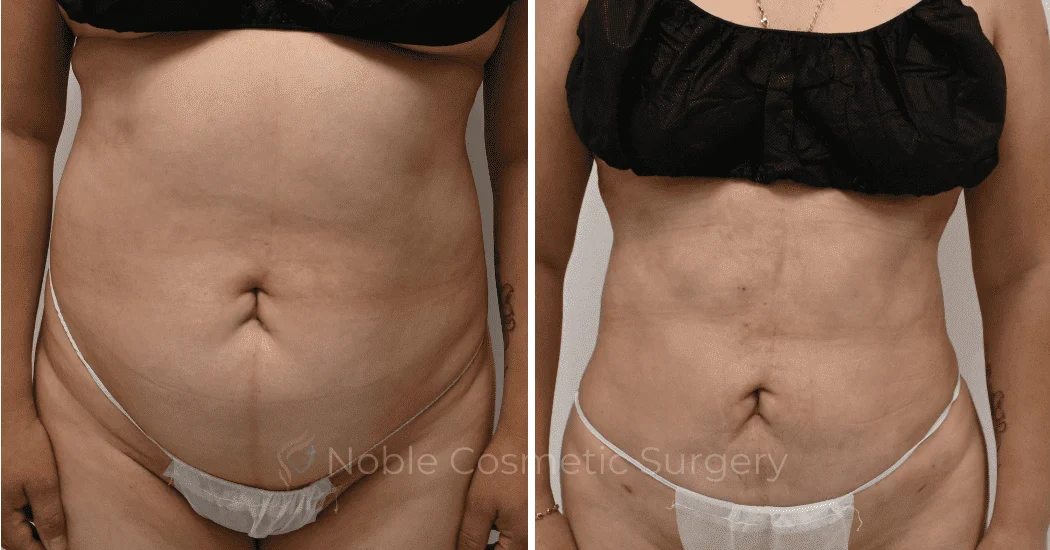 LIPOSUCTION-CASE-11116 | Before and After Liposuction 1