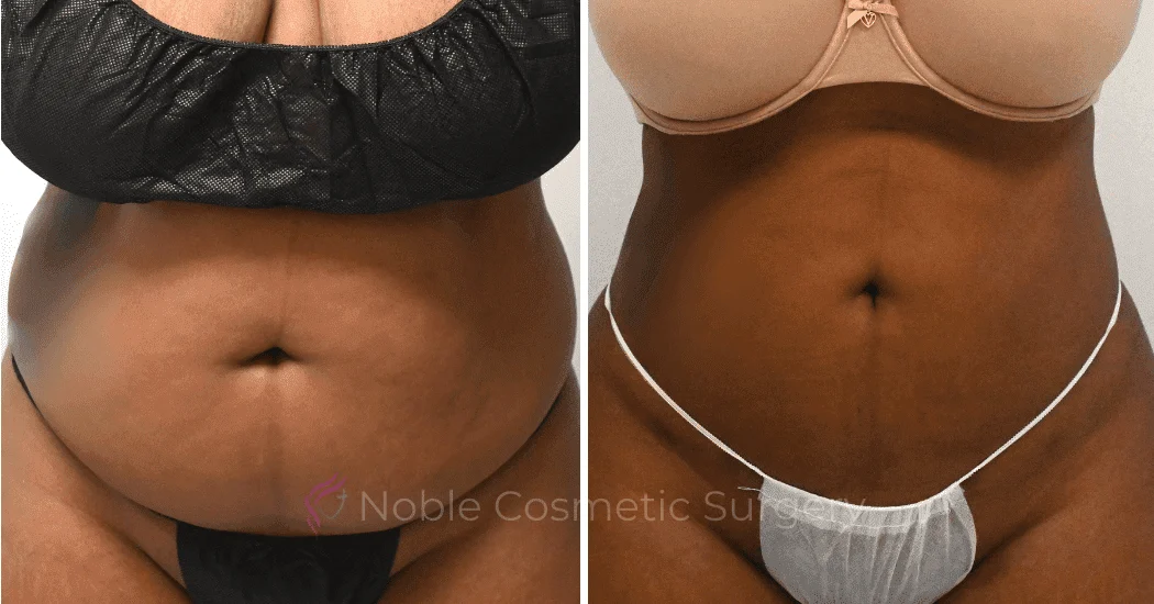 LIPOSUCTION-CASE-10271 | Before and After Liposuction 1