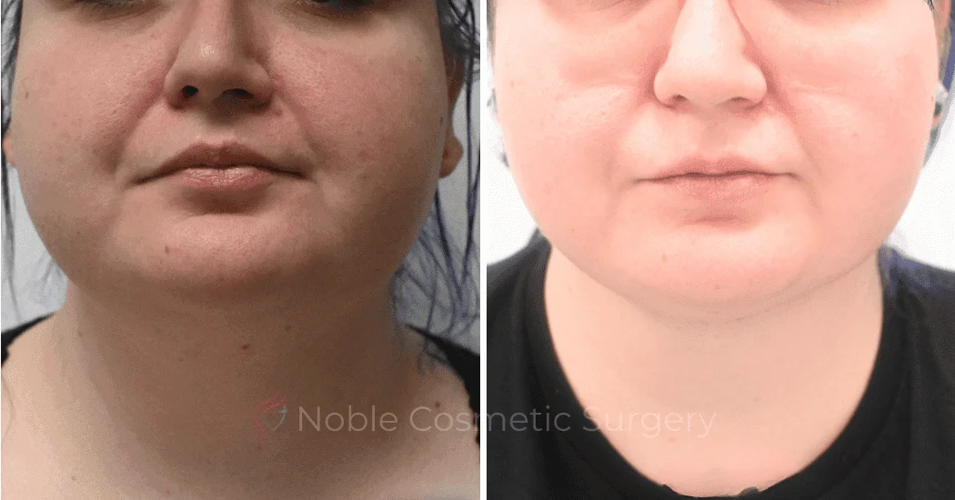 LIPOSUCTION-SUBMENTAL-CASE-19114 | Before and After Chin Liposuction 1