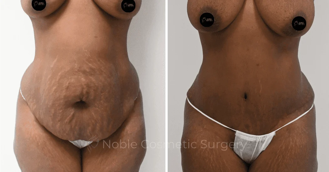 TUMMY-TUCK-CASE-10563 | Before and After Abdominoplasty 1