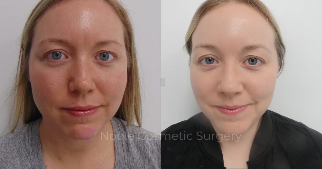 PICO-LASER-CASE-00005 | Before and After Pico Skin Rejuvenation 1